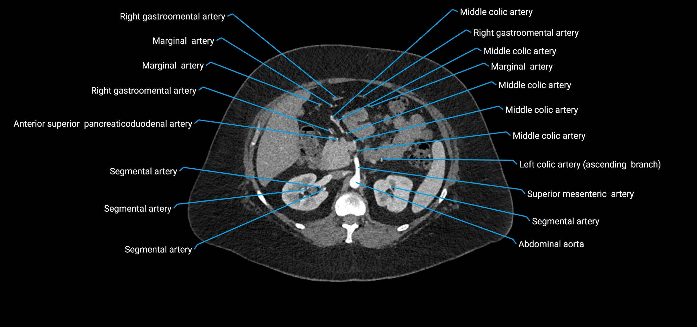 CTA abdomen axial cross sectional anatomy labelled image_67 (2).webp